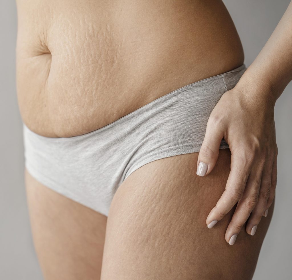 Stretch marks in teenagers 