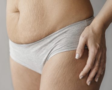 How Should You Deal With Stretch Marks in Teenagers
