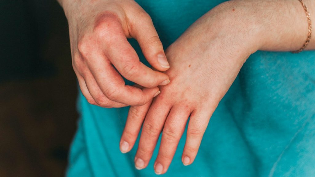 Warning signs, symptoms and treatment for eczema