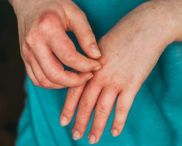 Warning signs, symptoms and treatment for eczema